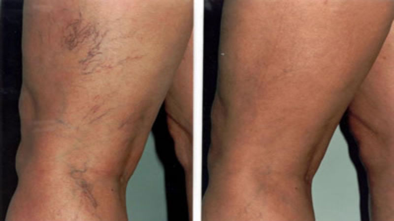 Options for Varicose Veins Treatment in San Jose