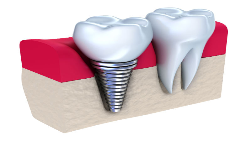 Your Smile Can Be Restored With Dental Implants in Keizer OR