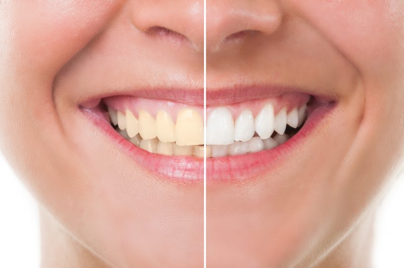 Advantages of Veneers