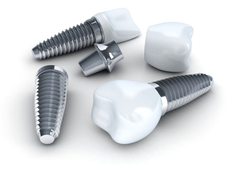 Understanding Dental Implants In Philadelphia