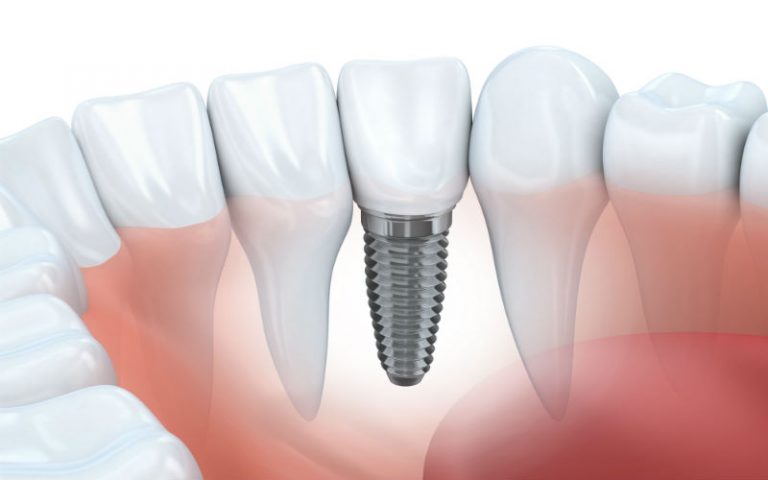 Advantages of Getting Dental Implants to Improve Your Oral Health