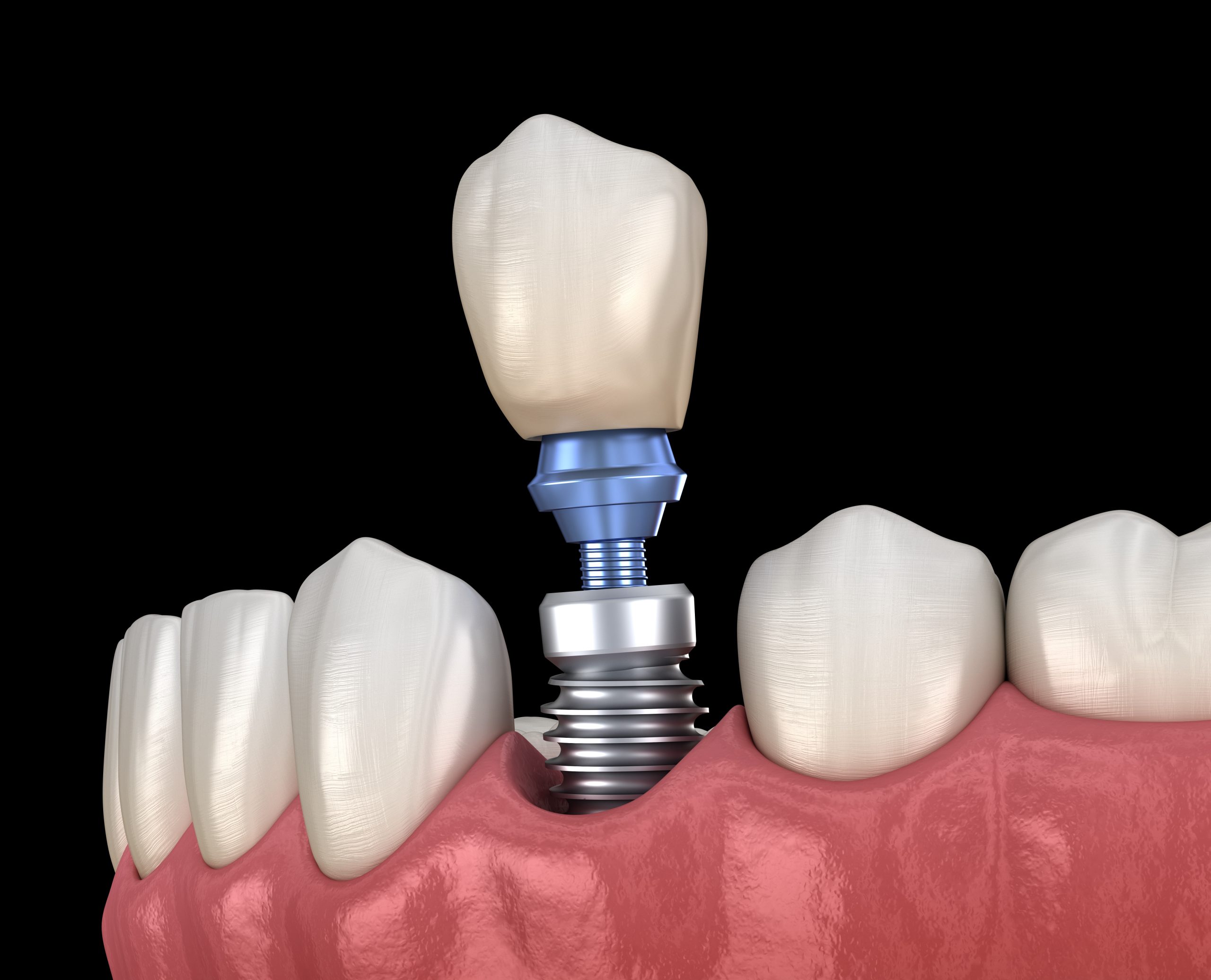 Your Guide to Choosing Dental Implants in Maplewood MN for a Perfect Smile