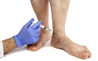 Lasting Comfort Awaits With Varicose Vein Treatment In New York Patients Trust Most