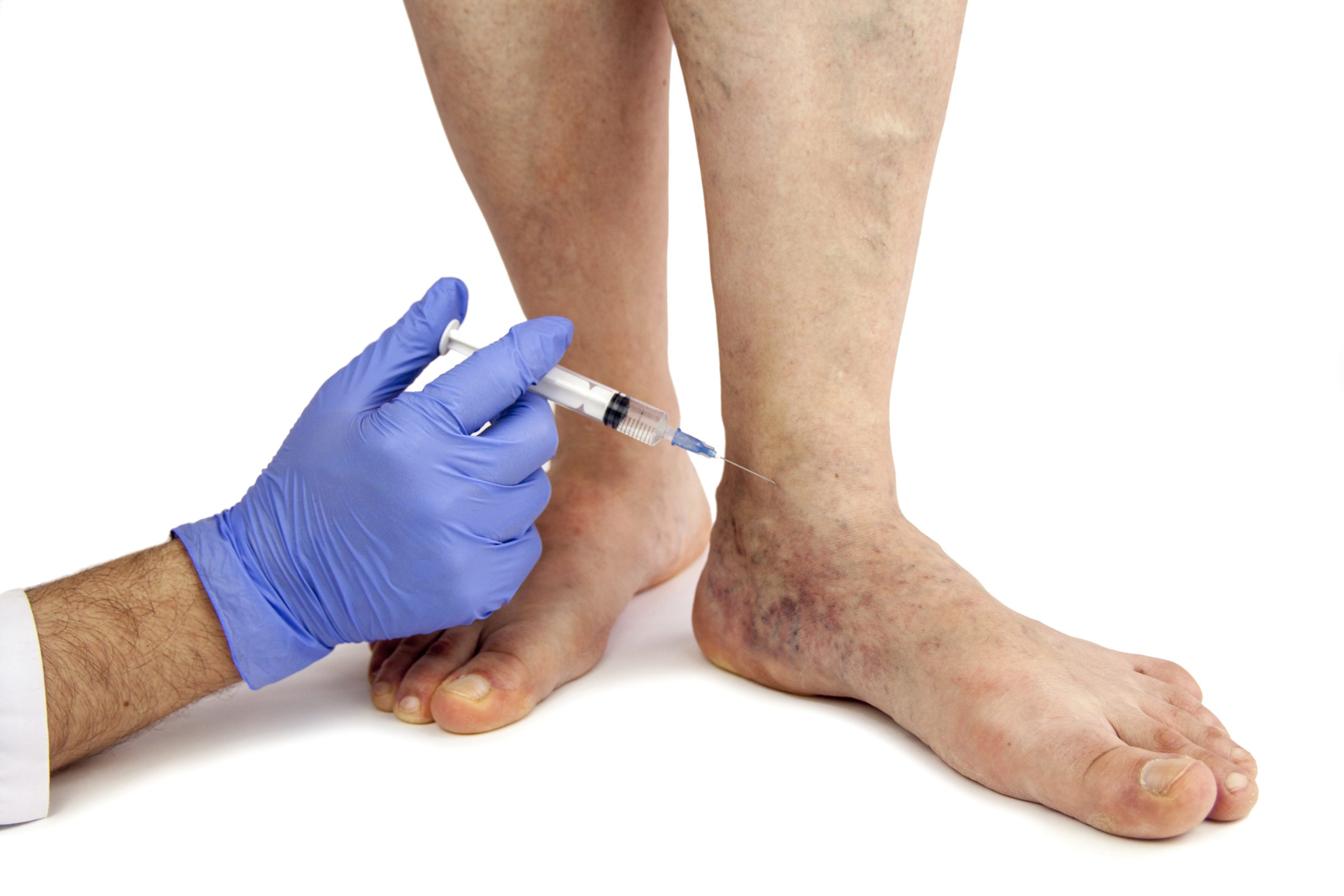 Lasting Comfort Awaits With Varicose Vein Treatment In New York Patients Trust Most